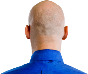 Indecisive Bald Guy